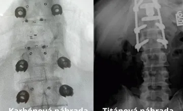 V martinskej nemocnici sa podarila výnimočná operácia. Pacientovi s rakovinou nahradili stavec